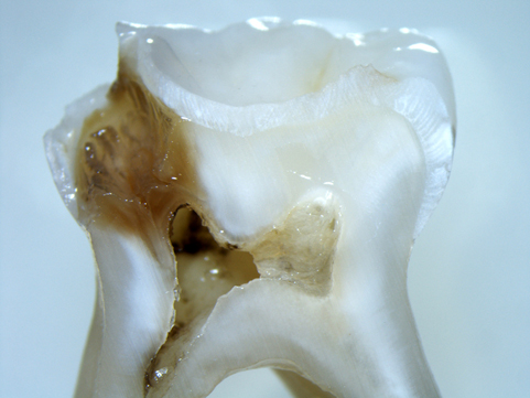 Types of teeth implants