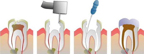 Types of teeth implants