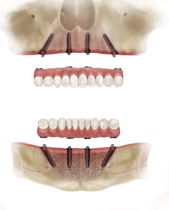 Types of teeth implants