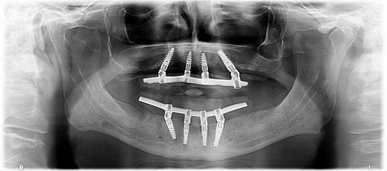 Types of teeth implants