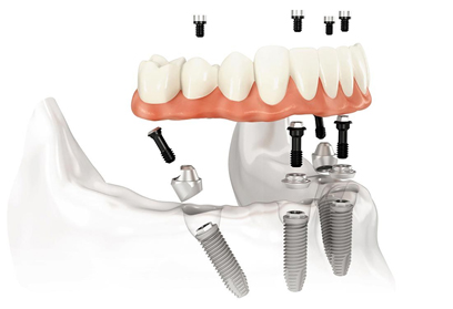 Types of teeth implants
