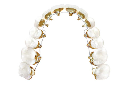 Types of teeth implants